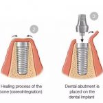 Advantages of Choosing Dental Implants in India