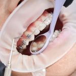 Orthodontic / Braces Treatment